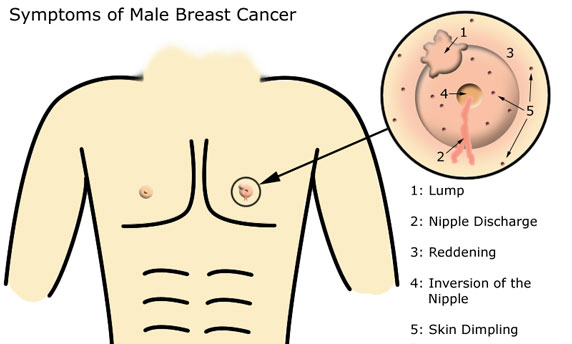 breast_cancer_male