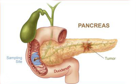 pancreatic cancer why so deadly