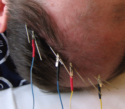 scalp-stroke