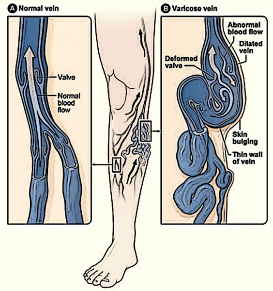 VaricoseVeins-564x600