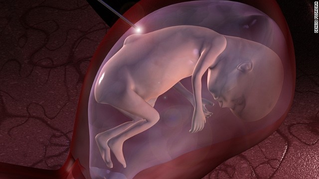surgery in the womb