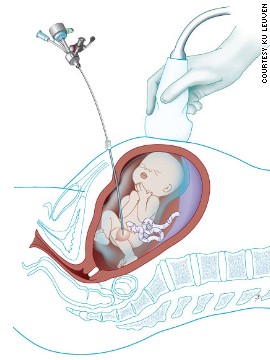 surgery in the womb2