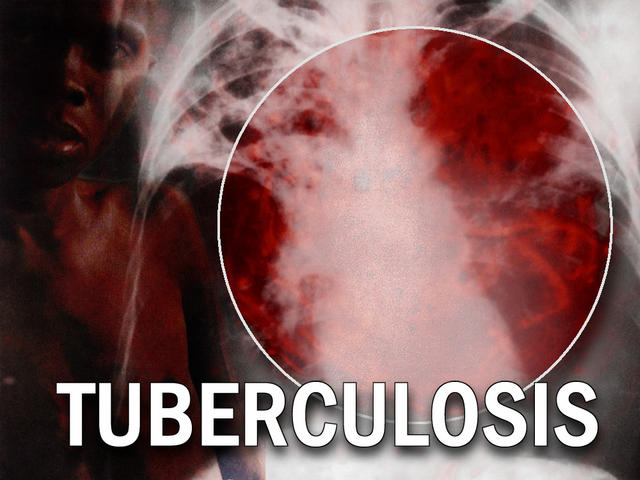 TB prevalence reduced