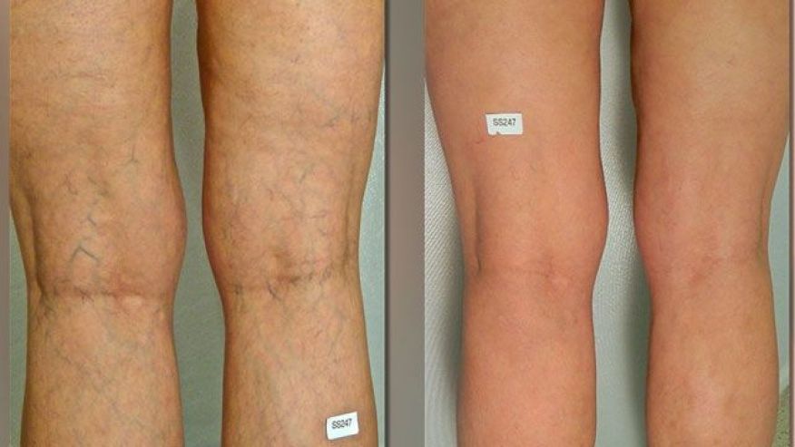 Makeup To Cover Varicose Veins On Legs  The World Of Make Up
